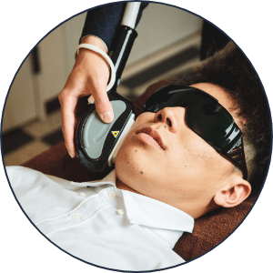 Beard 顔（ひげ）脱毛