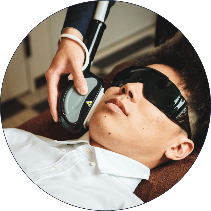 Beard 顔（ひげ）脱毛